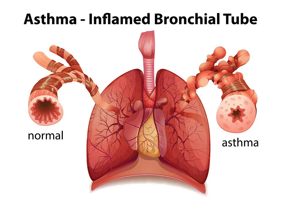 the allergy group asthma inflamed bronchial tube