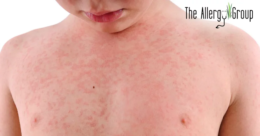 the allergy group getting rid of hives blog