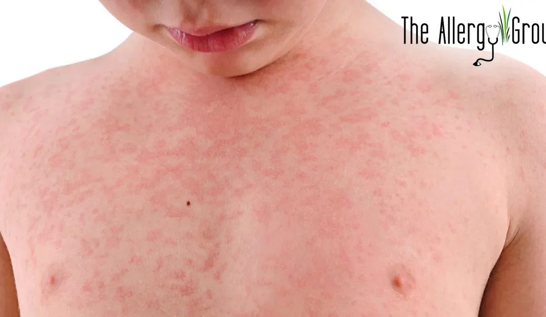 the allergy group getting rid of hives blog